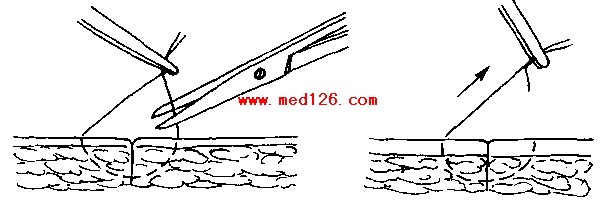 最新外科拆线技术革新及临床应用探讨